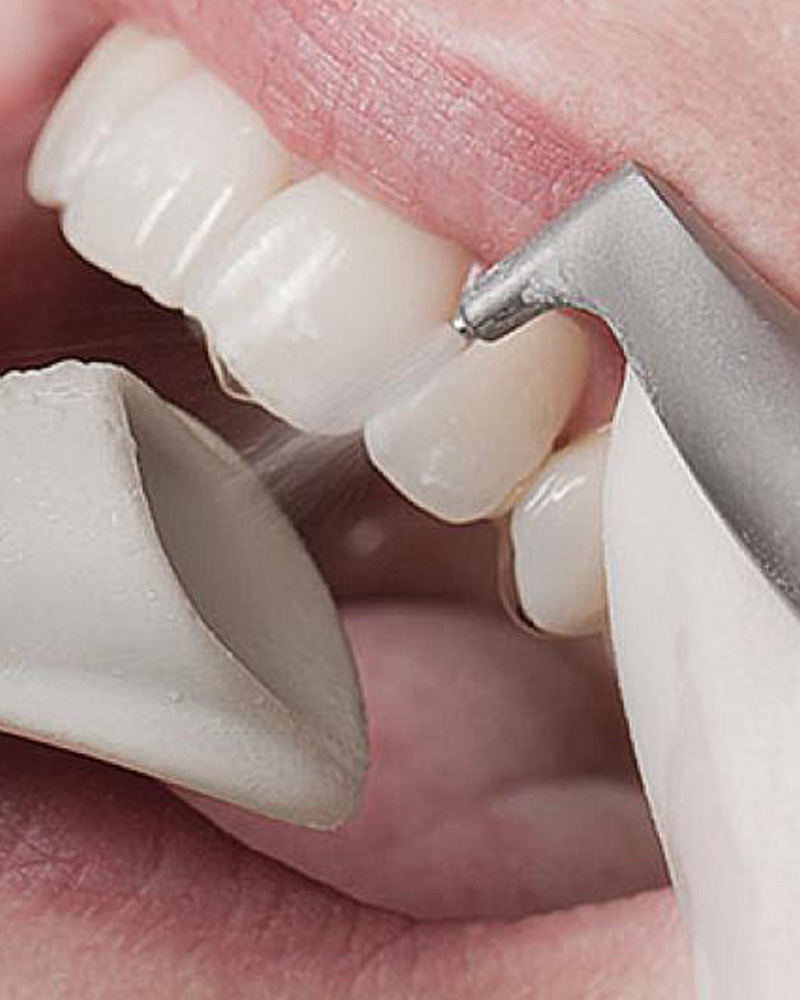 Airflow Guided Biofilm Therapy Painless Dental Hygiene London