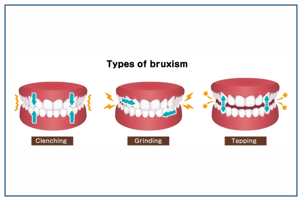 teeth grinding and bruxism