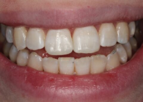 composite bondings on front teeth