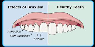 effect of bruxism