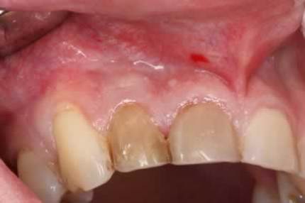 Before After Root Canal Treatment/ Apicectomy - Upper lateral incisor pain
