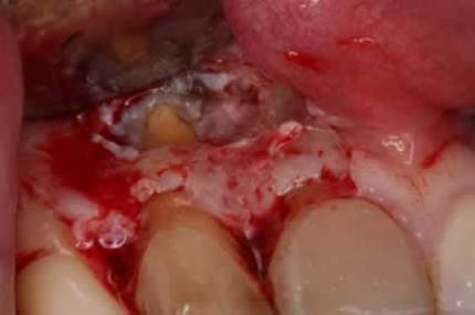 Before After Root Canal Treatment/ Apicectomy - Visible root apex after removing bone