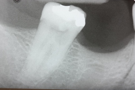 Before After Root Canal Treatment - Decayed tooth X-ray
