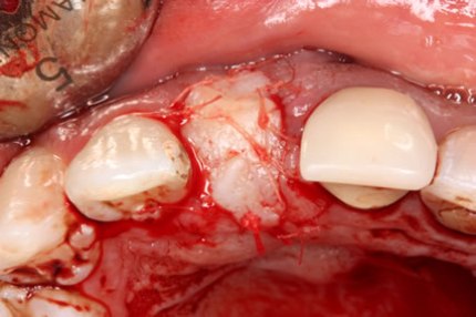 Soft Tissues Grafting Before After - Newly formed bone implant after six months