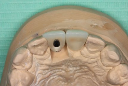 Soft Tissues Grafting Before After - Front tooth crown changed aesthetics
