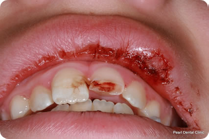 Dental Trauma Teeth Before After 