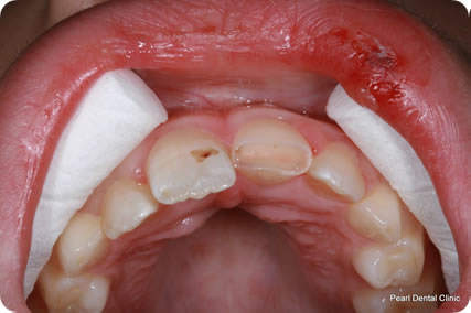 Dental Trauma Teeth Before After 