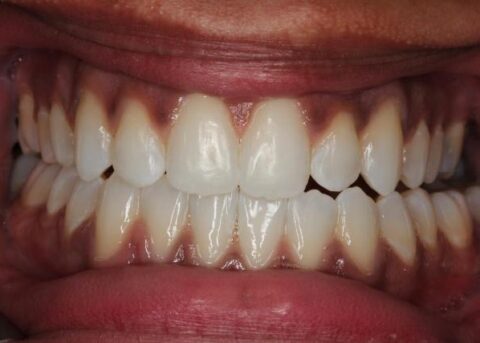 invisalign after front view