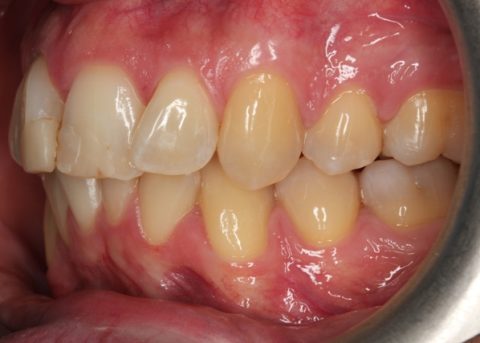 invisalign before side view.jpg