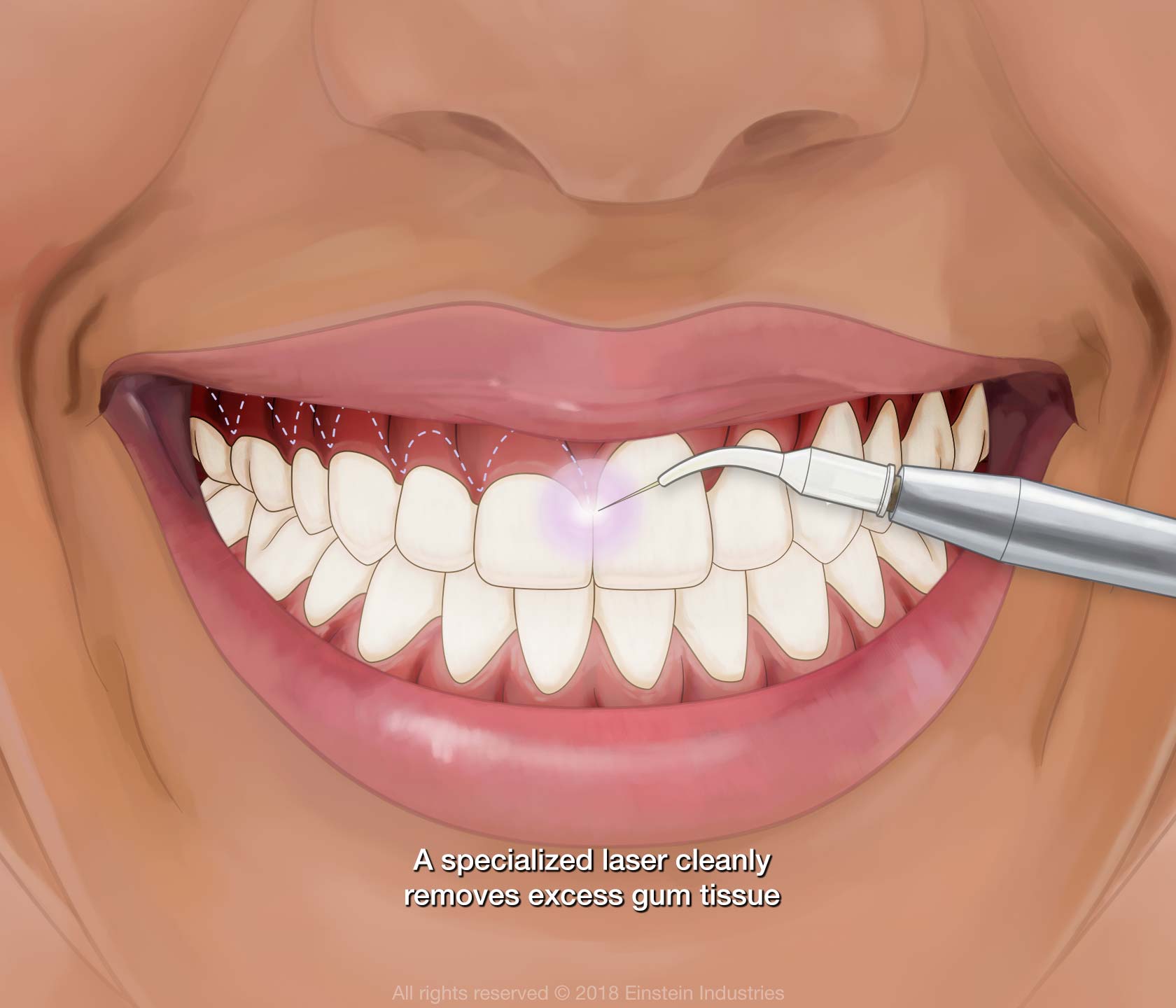 Gum contouring surgery