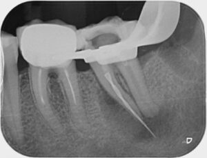 fractured endodontic instrument