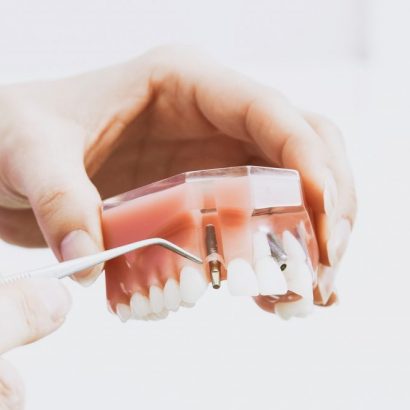 Dental Implant Finance