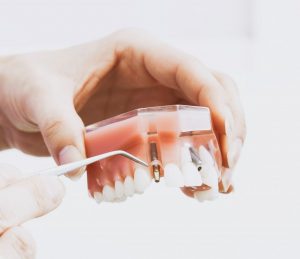 Revolutionary new dental abutment that treats infection