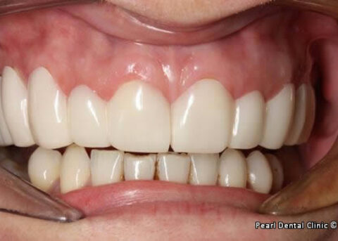 snap on smile Full arches right side teeth after
