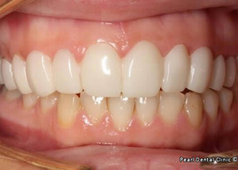 snap on smile Full upper_lower arches teeth after