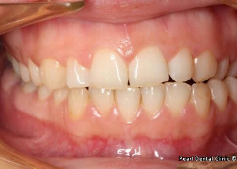 snap on smile Full upper_lower arches teeth before