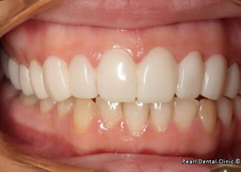 snap on smile Full upper_lower left side arches teeth after
