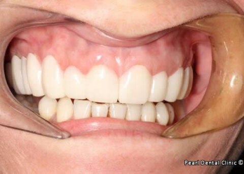snap on smile Full upper_lower arches right side teeth before