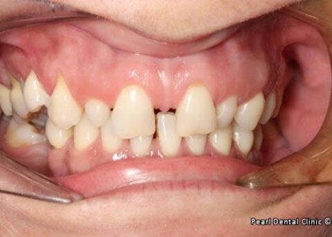 snap on smile Full upperlower arches right_side teeth before