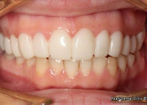 snap on smile Full upperlower arches teeth after