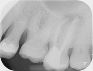 complex root canal treatment