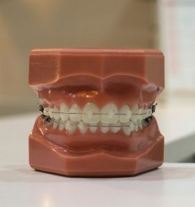 Types Of Braces For Teeth
