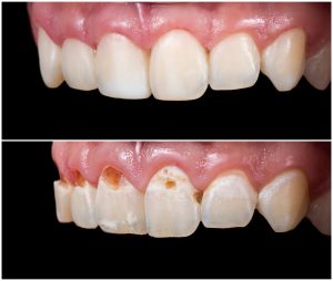 tooth decay