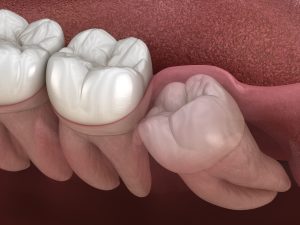 wisdom tooth