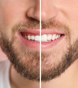 gingivectomy