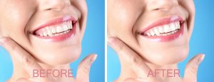 gingivectomy