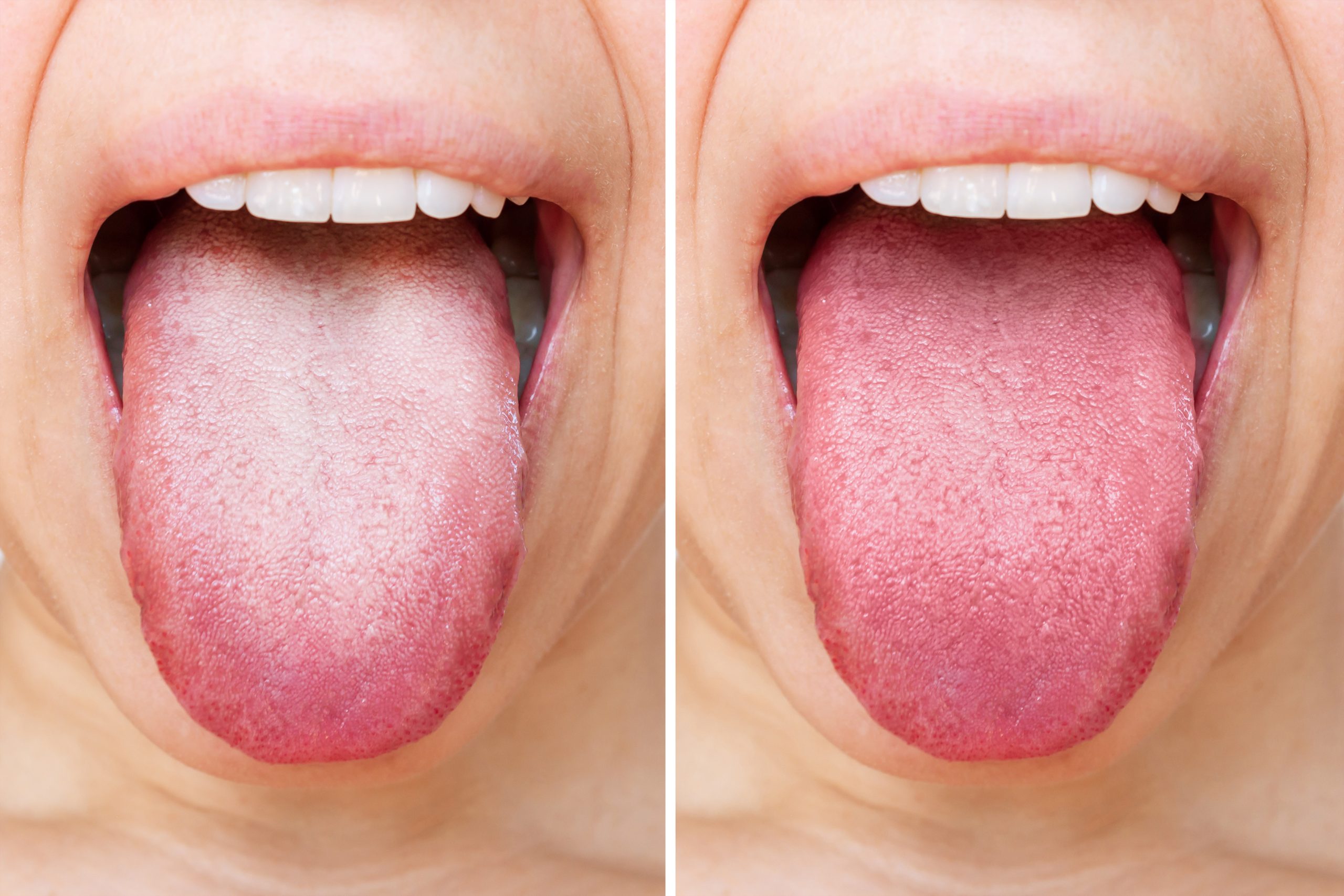 tongue cleaning