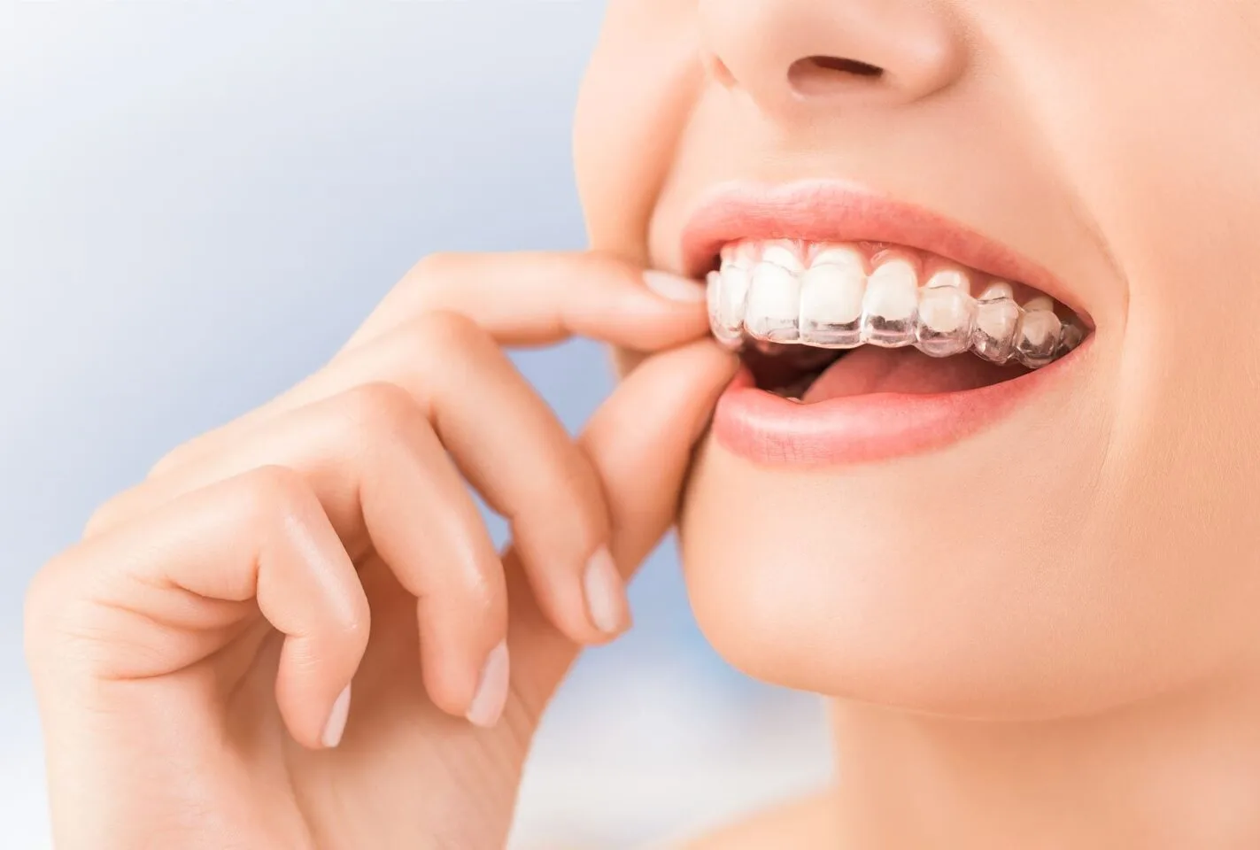 Vivera Retainers
