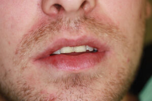Worn_Chipped Teeth Before - Front worn_chipped teeth