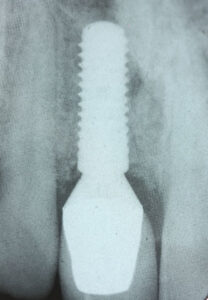 Before After Missing Front Tooth - Straumann SLActive implant placed