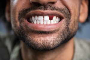 lost tooth