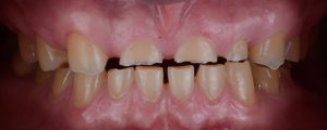 chipped teeth
