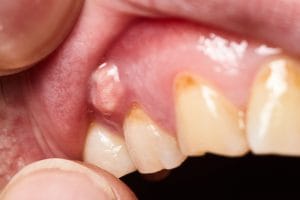 lump in the mouth