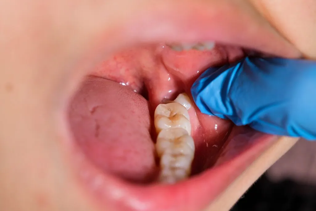 Lump In Mouth