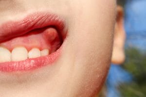 swelling on gum