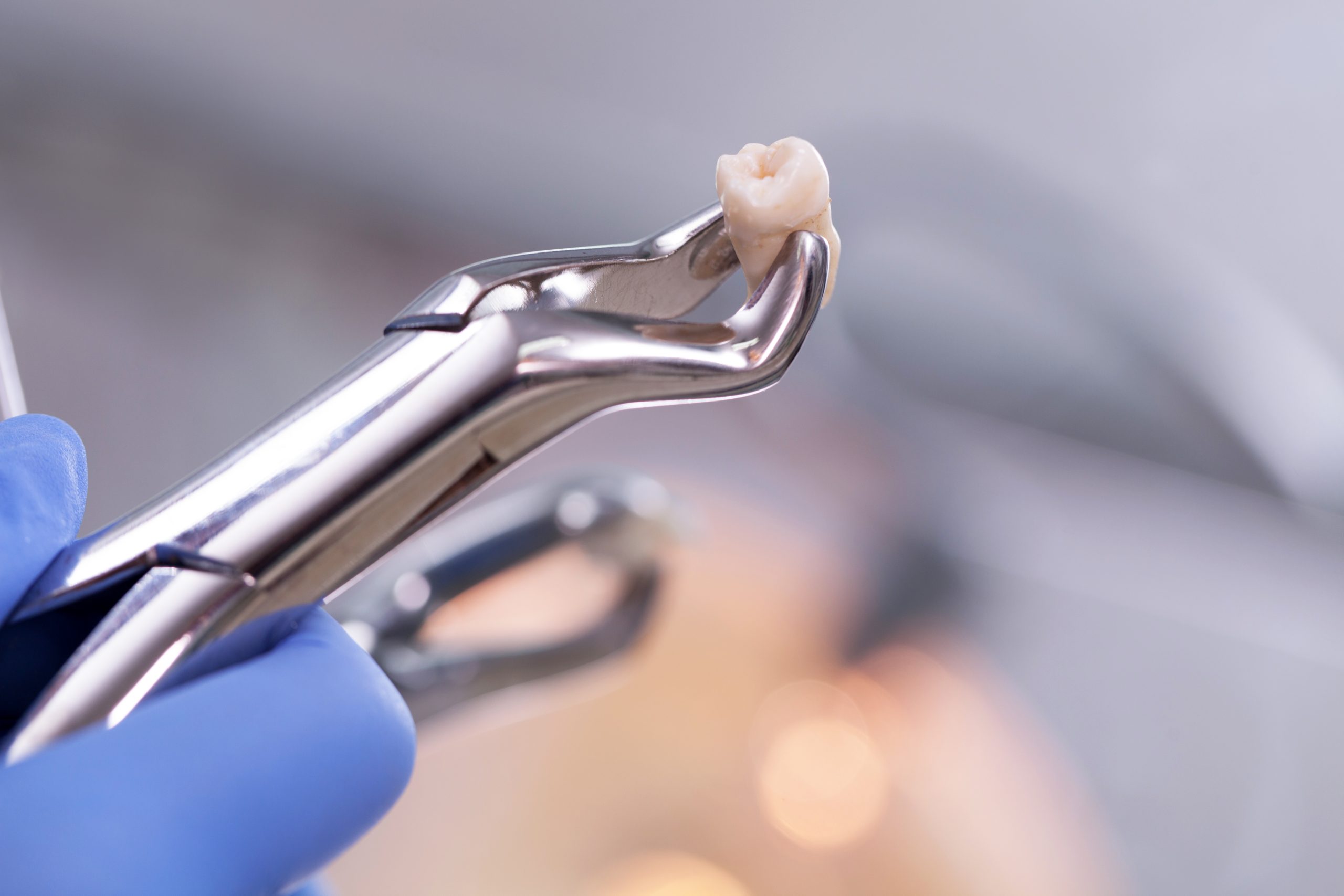 wisdom tooth infection