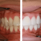 A Guide To Teeth Veneers