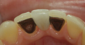 maryland dental bridges