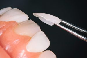 No Preparation Veneers