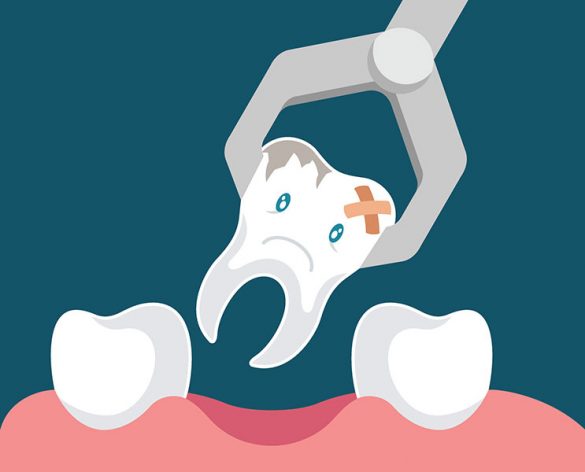 tooth extraction