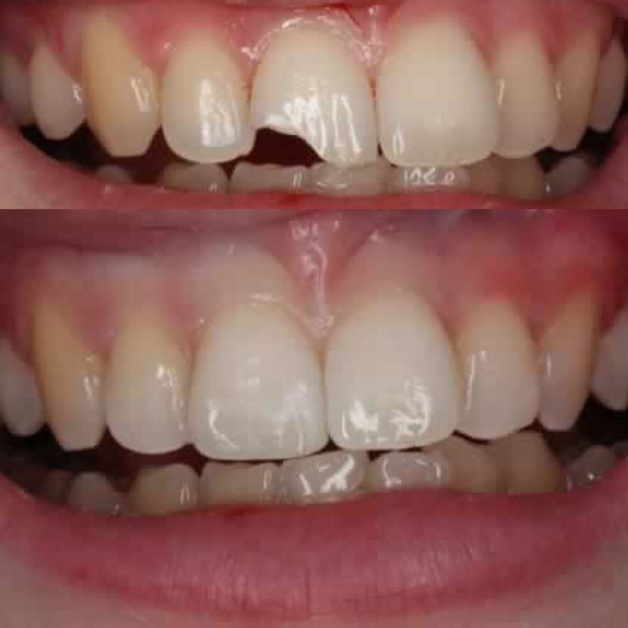 Repairing Chipped Teeth