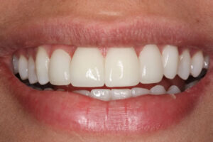 Why Are Lumineers Different?