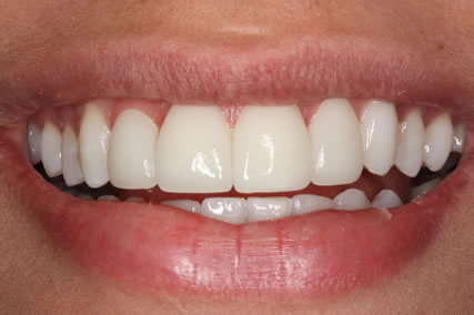 Why Are Lumineers Different?