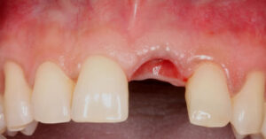 Front Tooth Implant