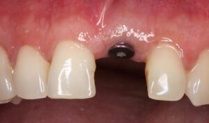 Front Tooth Implant