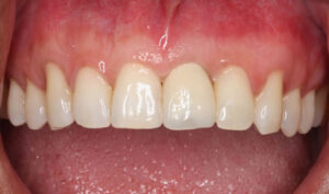 Front Tooth Implant
